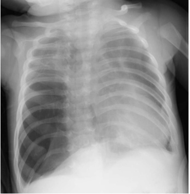 chest-xr